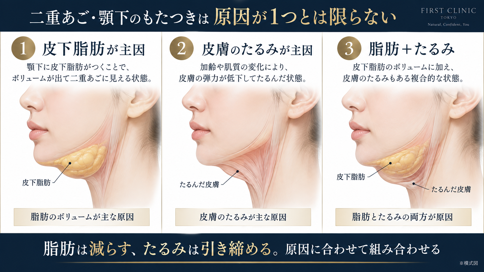 二重顎・顎下のもたつきの原因を3タイプに分けた模式図