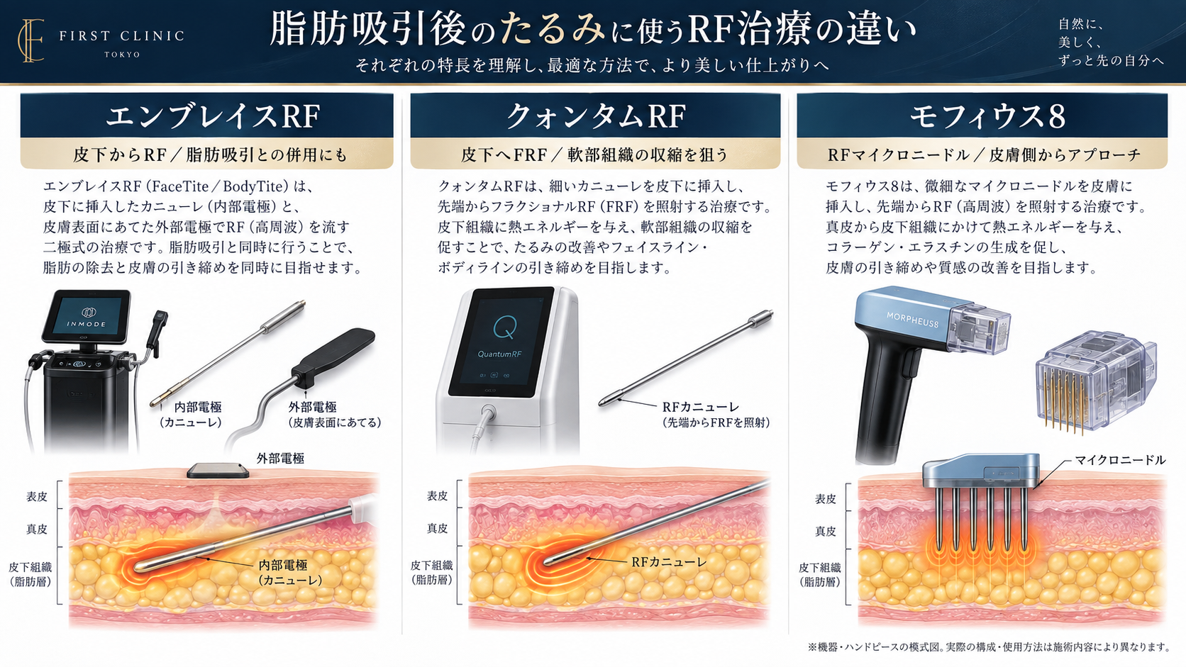 エンブレイスRF・クォンタムRF・モフィウス8の違いを示した機器・作用模式図