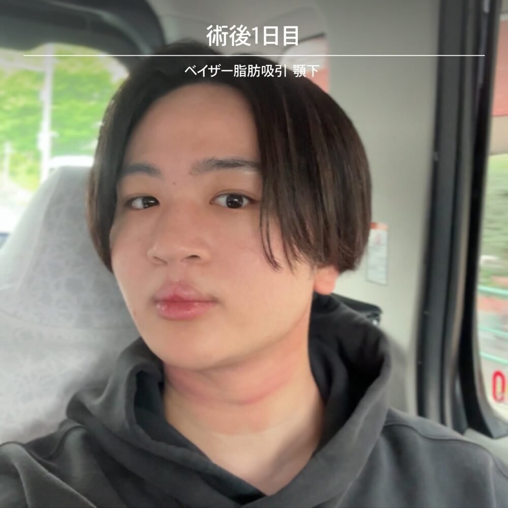 顔の脂肪吸引のダウンタイム経過の症例写真