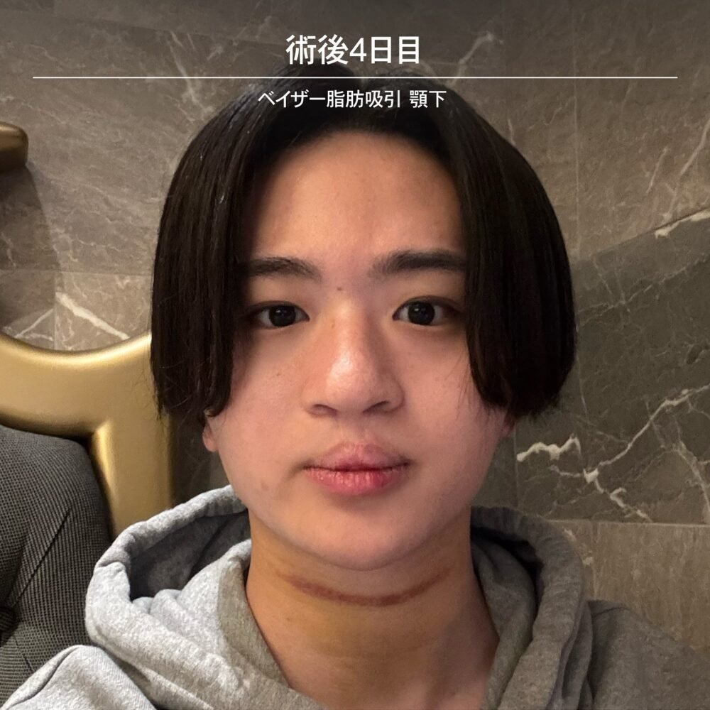 顔の脂肪吸引のダウンタイム経過の症例写真