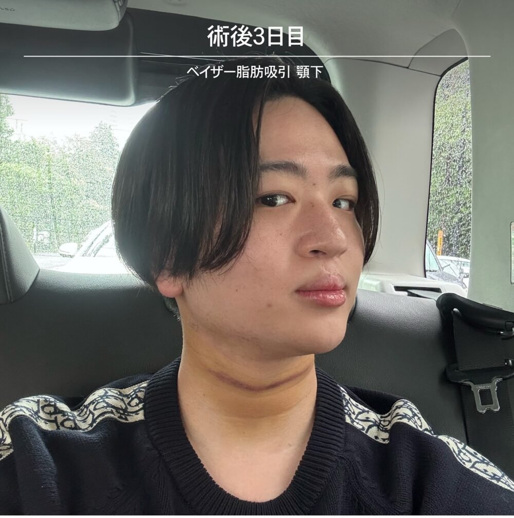 顔の脂肪吸引のダウンタイム経過の症例写真