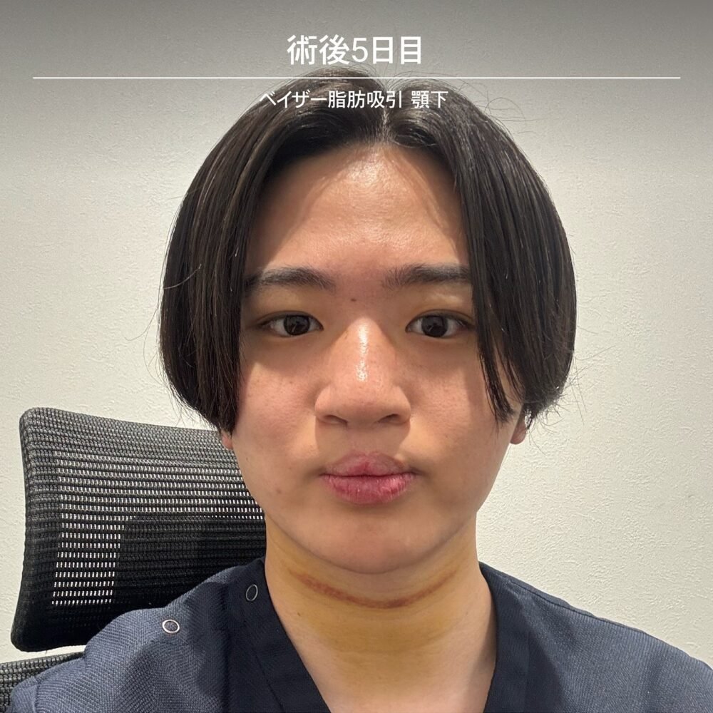 顔の脂肪吸引のダウンタイム経過の症例写真