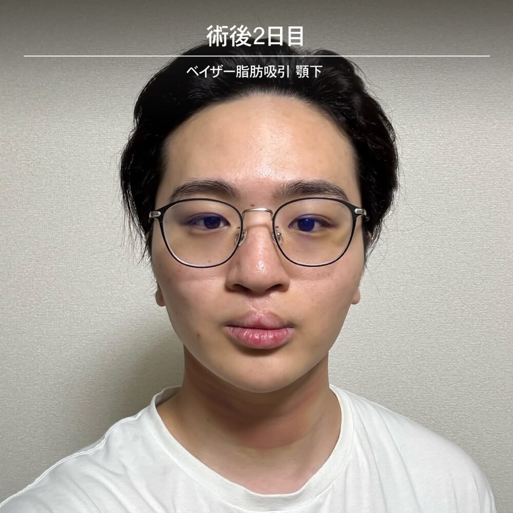 顔の脂肪吸引のダウンタイム経過の症例写真