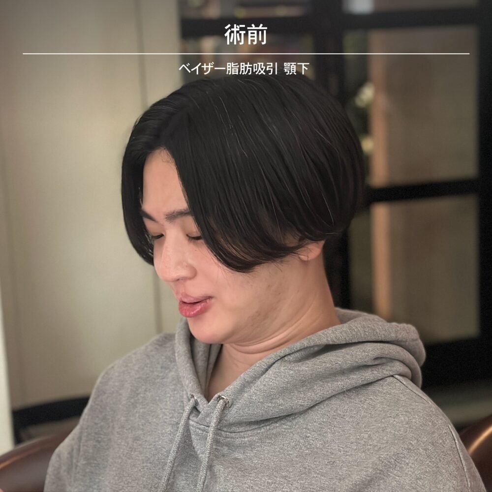 顔の脂肪吸引のダウンタイム経過の症例写真