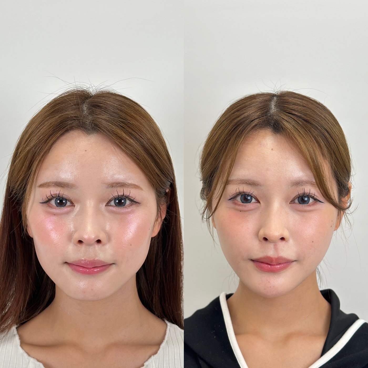 小顔脂肪吸引 頬 顎下 ジョールファット エンブレイスRF 糸リフト 脂肪注入