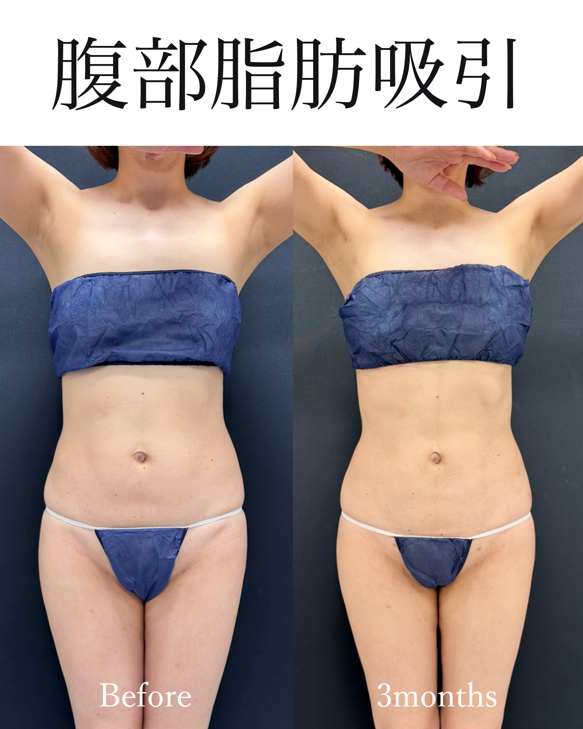 腹部脂肪吸引の症例 術前と術後3ヶ月の正面比較