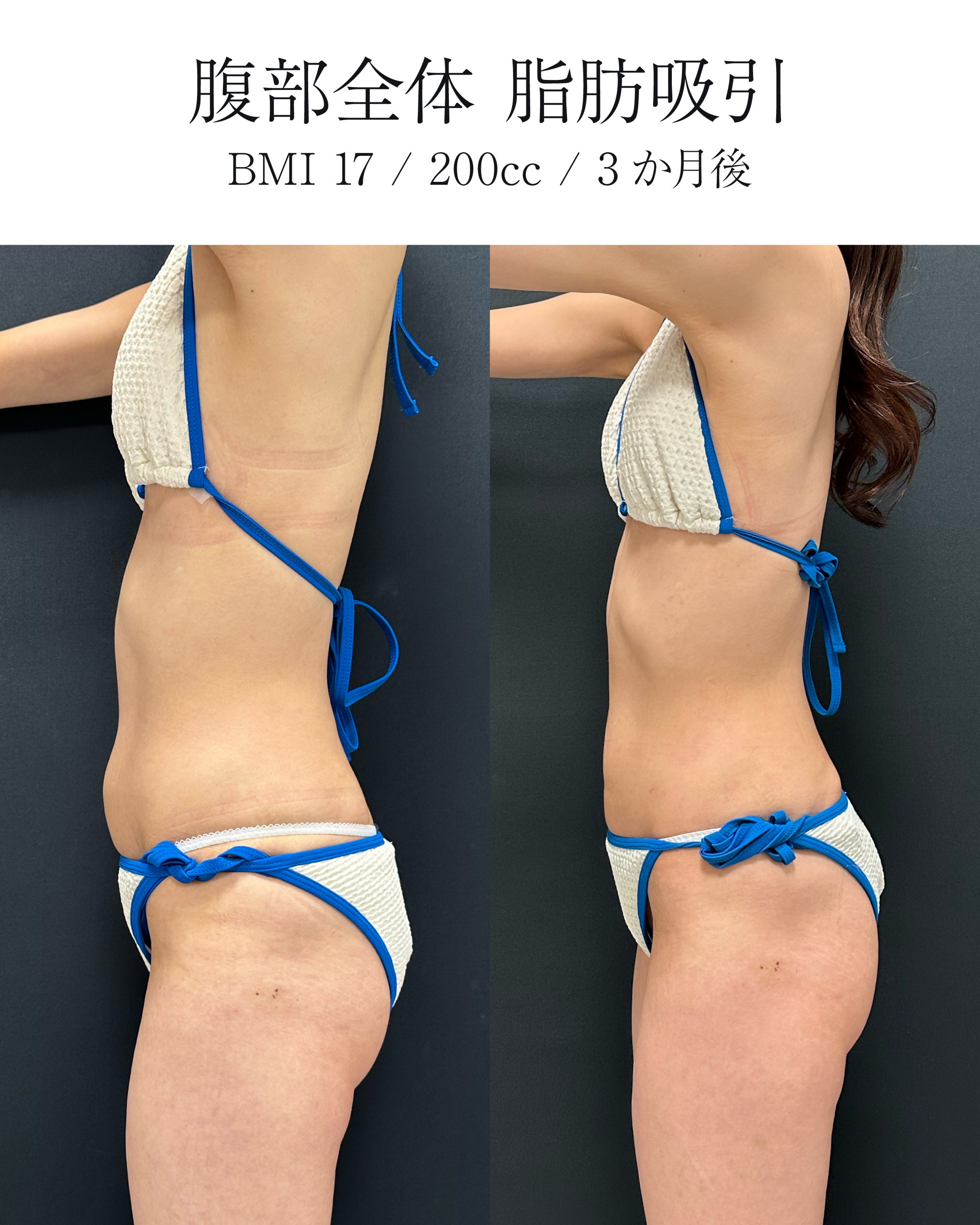 腹部全体脂肪吸引の症例 BMI17 200cc 術後3ヶ月の側面比較