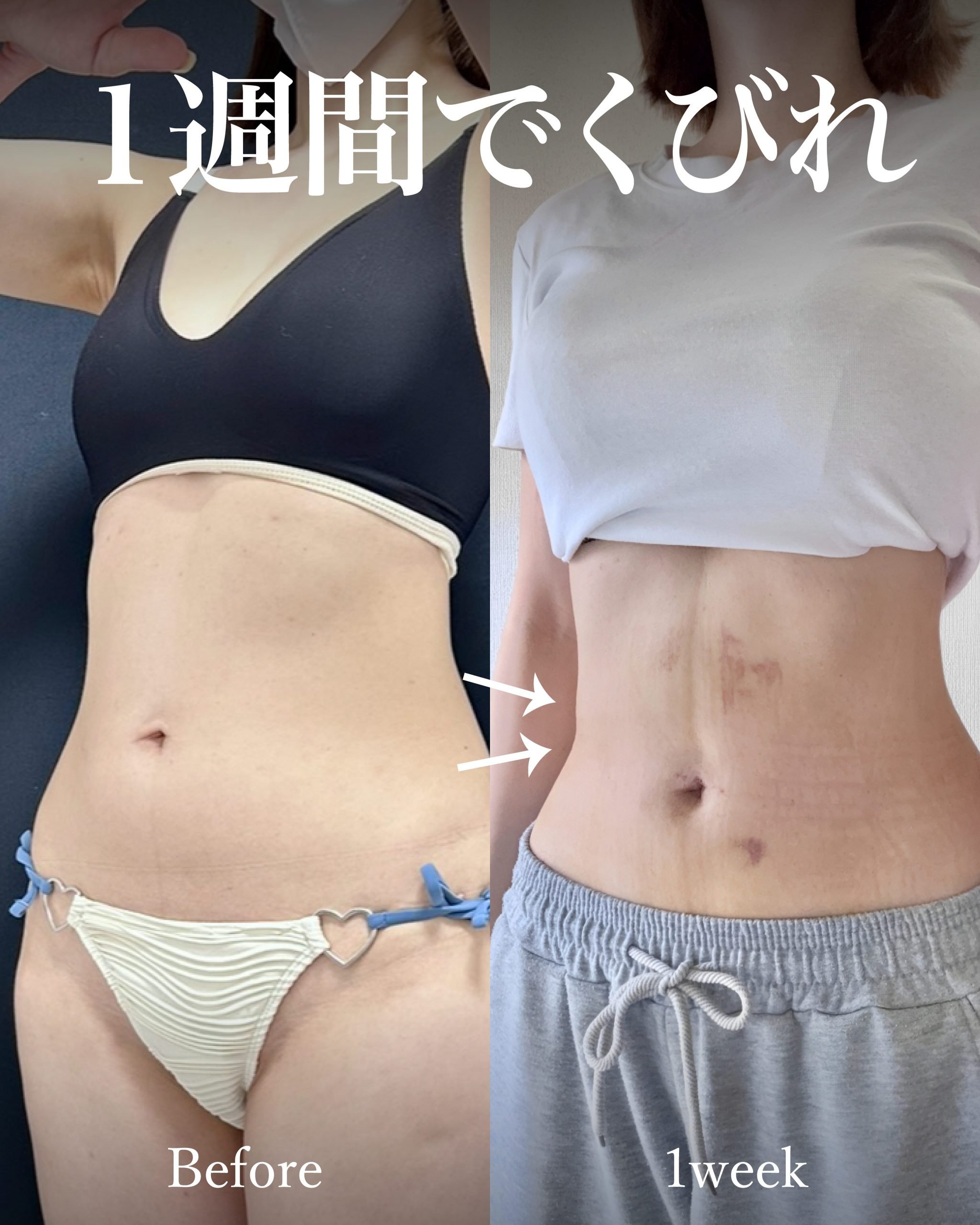 お腹脂肪吸引の症例 術後1週間でくびれが出てきた経過