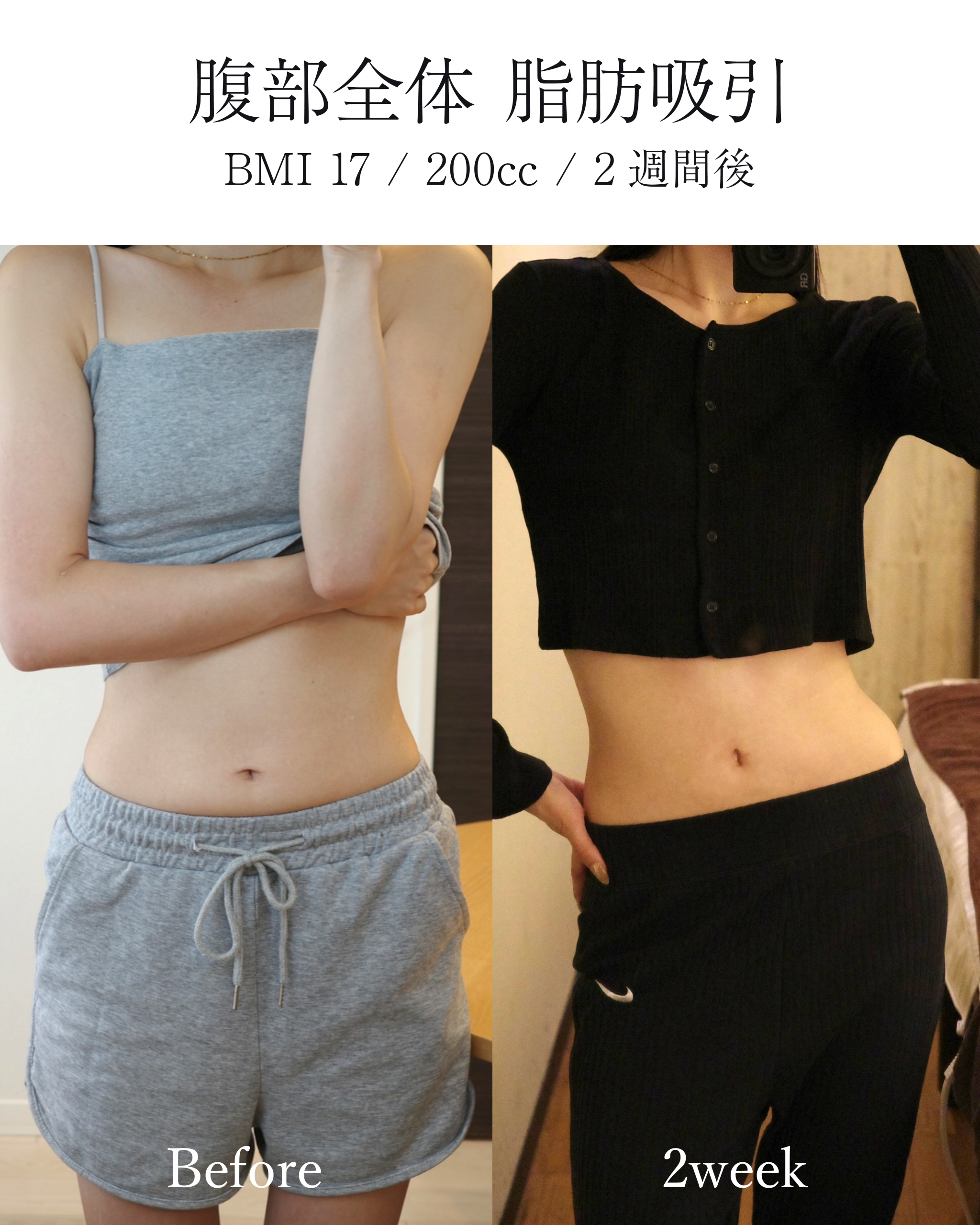 腹部全体脂肪吸引の症例 BMI17 200cc 術後2週間の変化