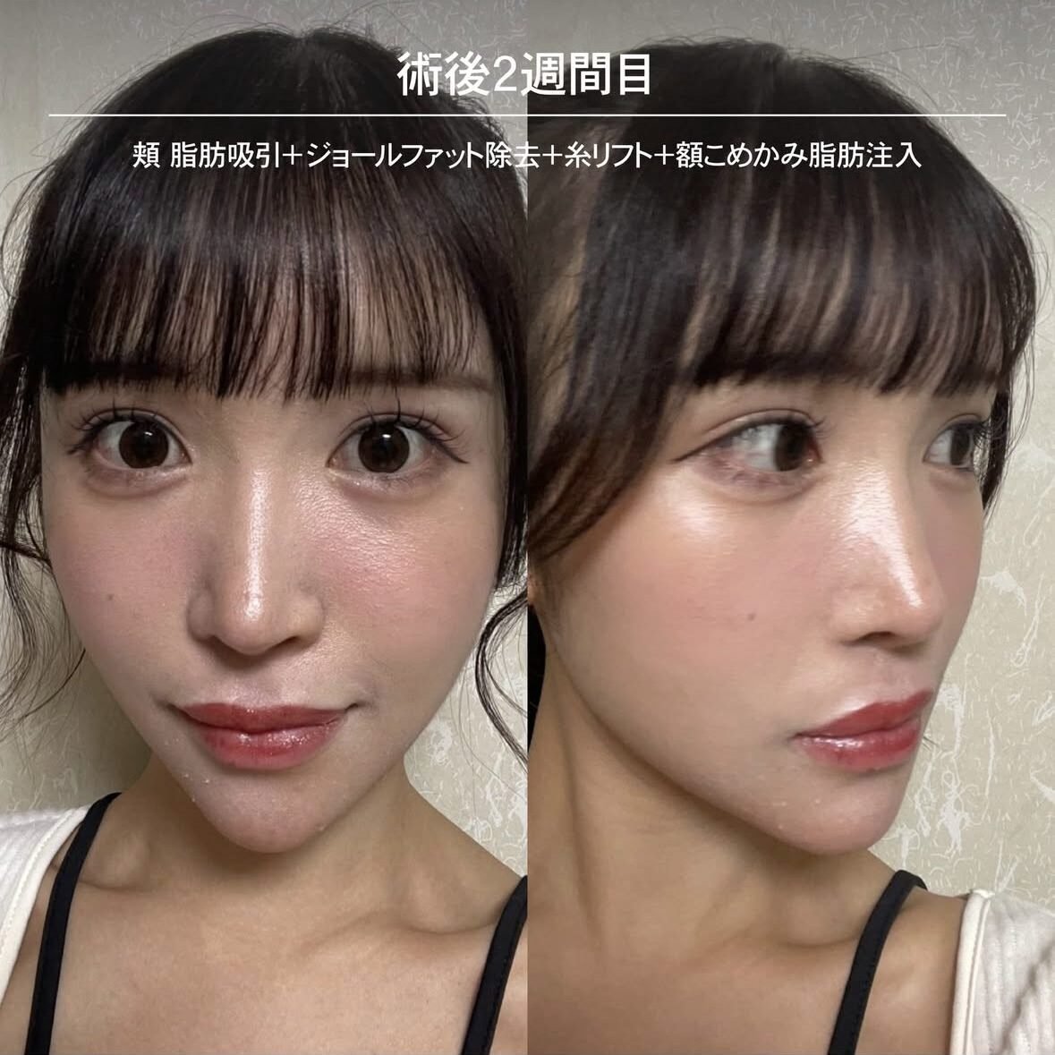 顔の脂肪注入のダウンタイム症例 術後2週間目