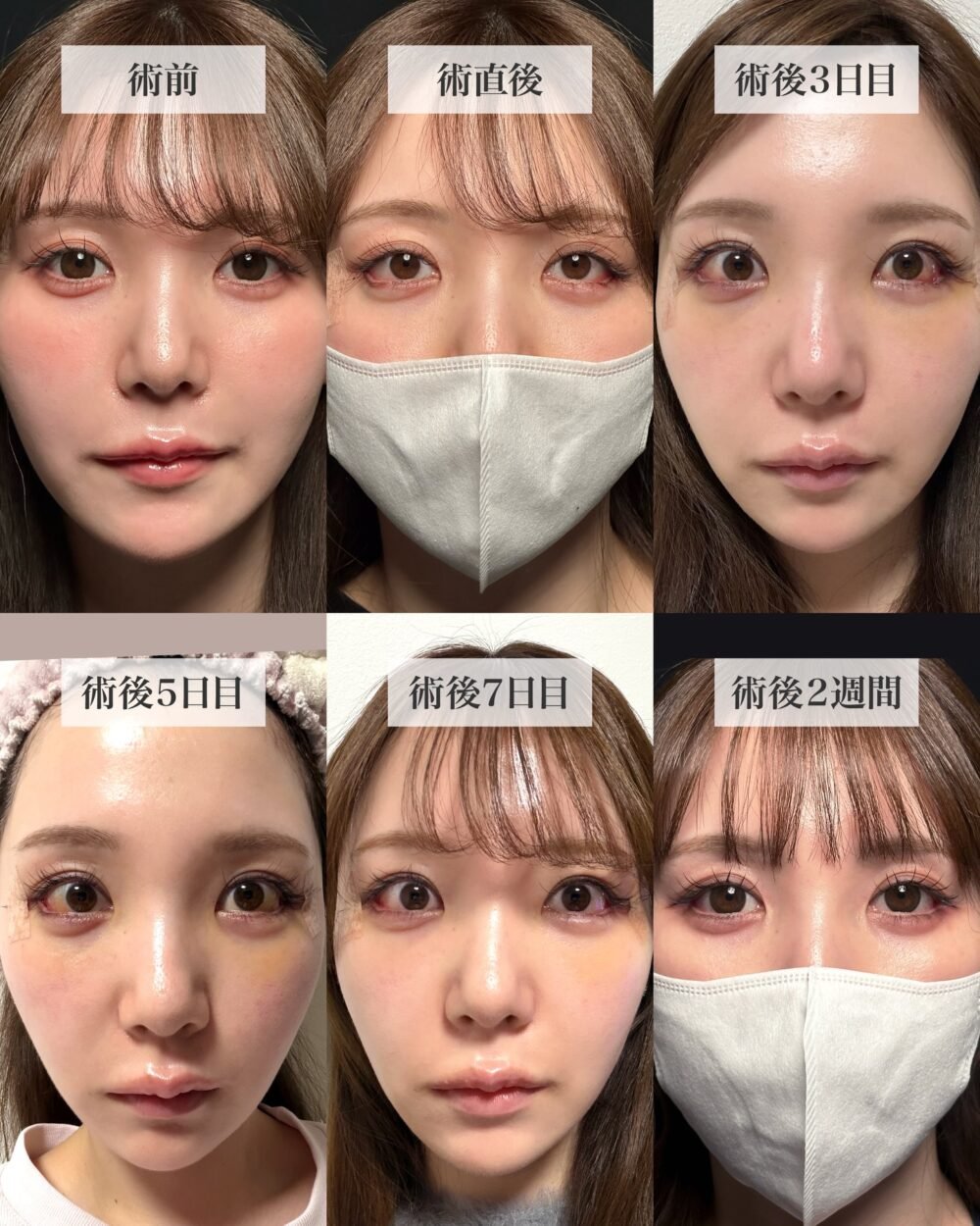 タレ目形成の症例写真