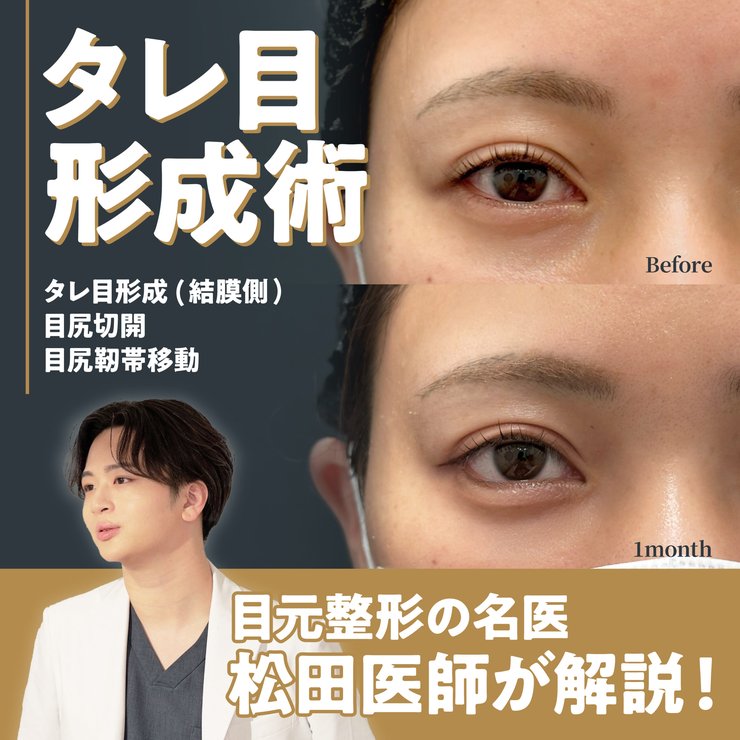 【2026年最新】タレ目形成（グラマラスライン）の名医 松田医師が失敗しないポイントと医師選びを解説