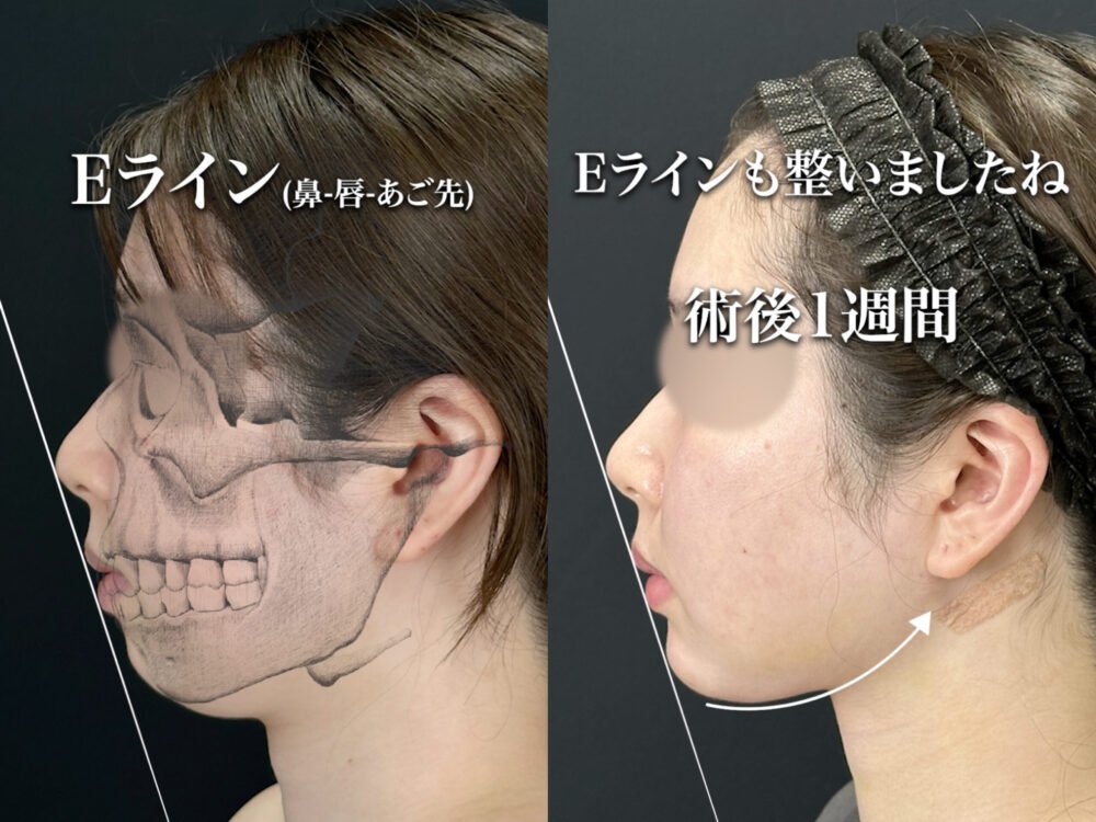 小顔脂肪吸引の解説動画のスクリーンショット