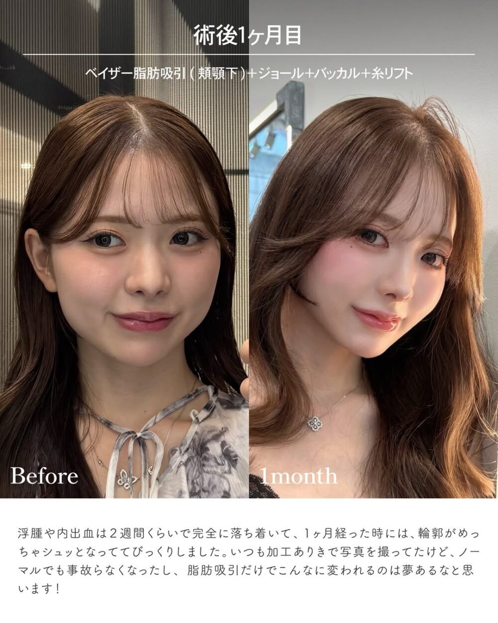 エンブレイスRFの症例写真