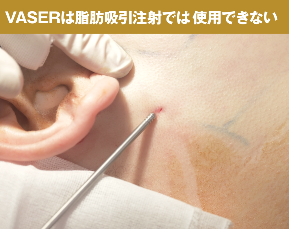 Vaser（ベイザー）は脂肪吸引注射では使用不可