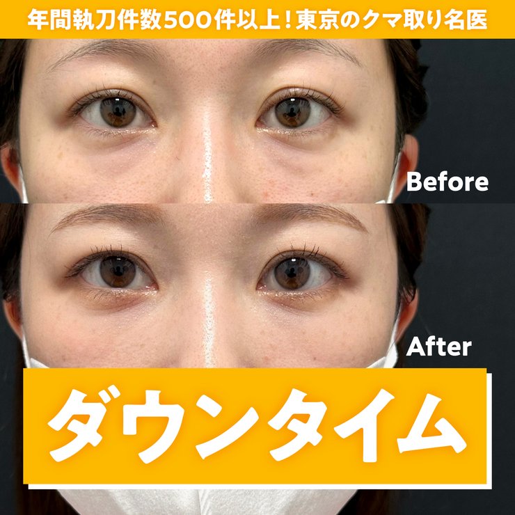 【医師監修】クマ取りのダウンタイムについて解説〈東京・六本木のFirst Clinic〉