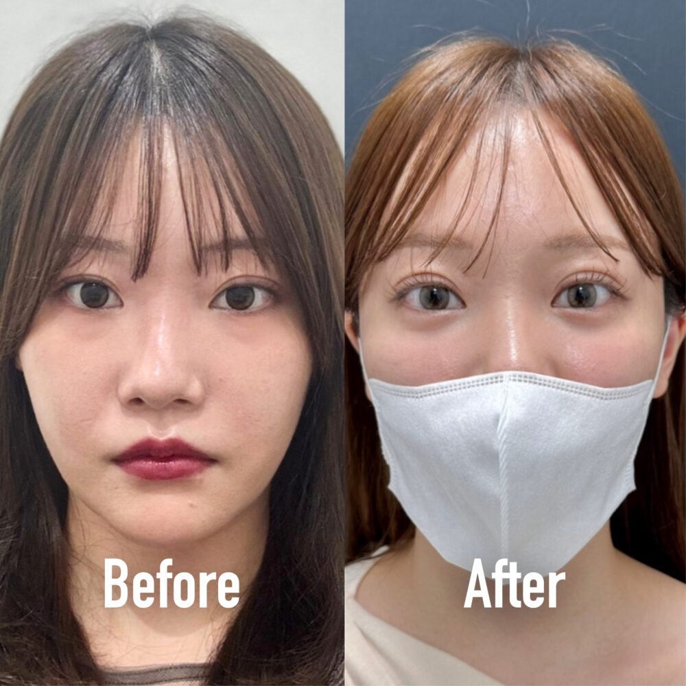切らない涙袋形成の症例写真