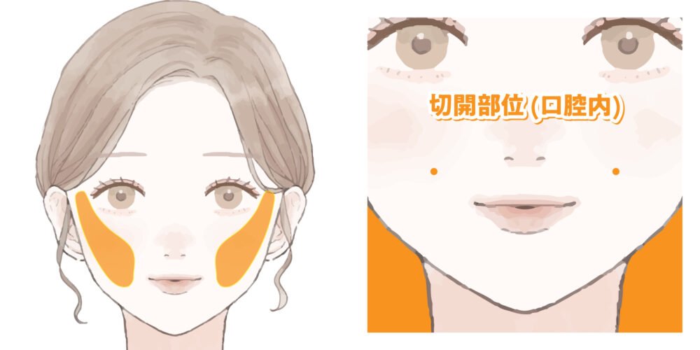 小顔脂肪吸引の解説画像