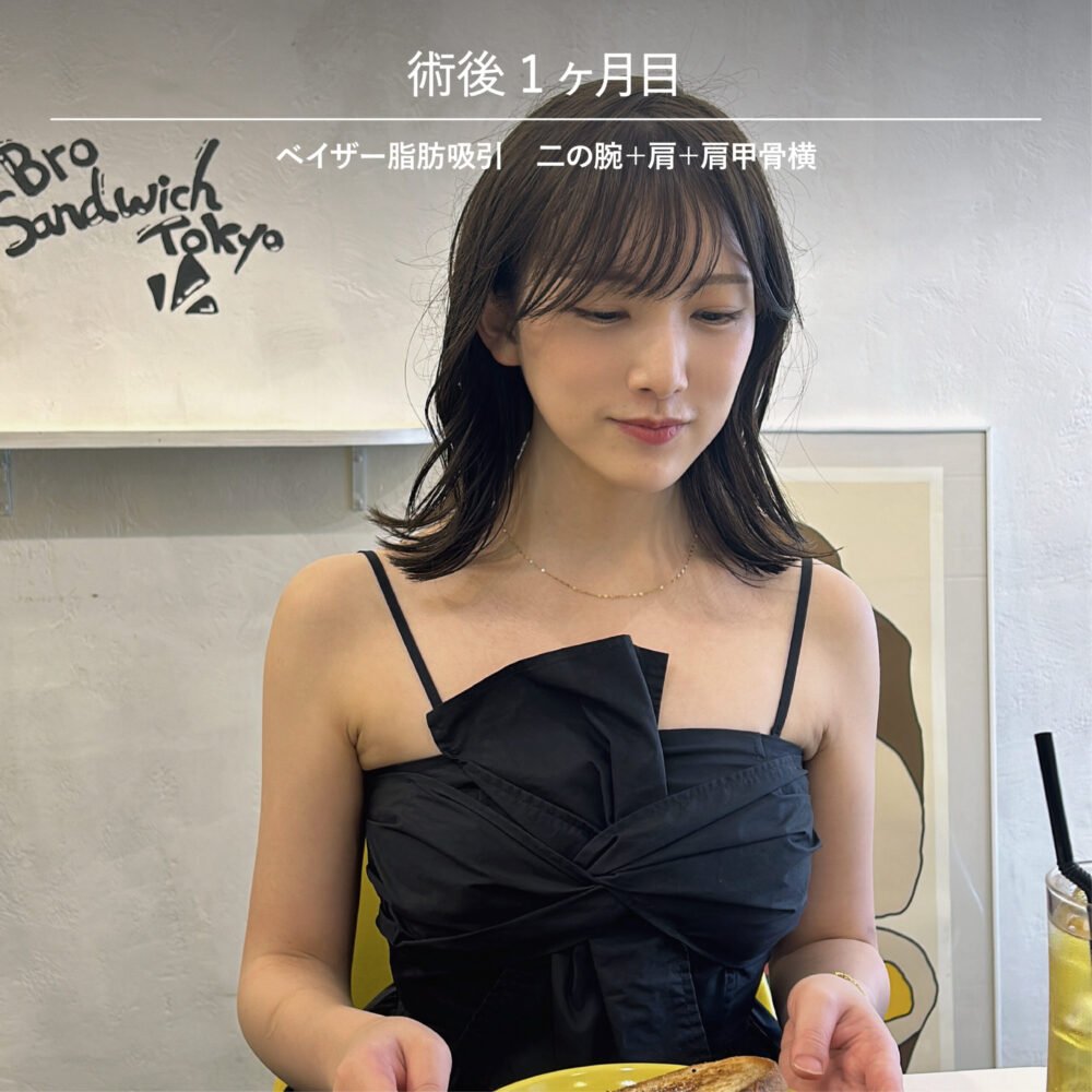 二の腕脂肪吸引のダウンタイム経過の症例写真