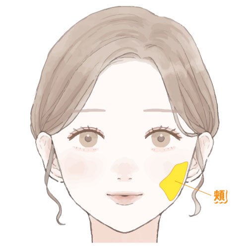 頬の脂肪吸引の施術部位イラスト