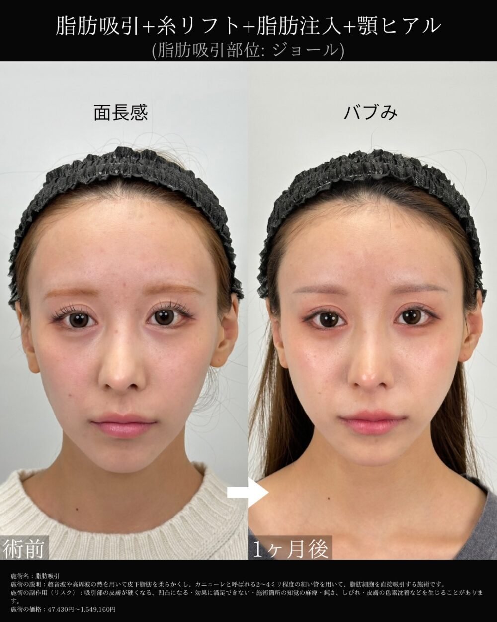 顔の脂肪吸引の症例写真
