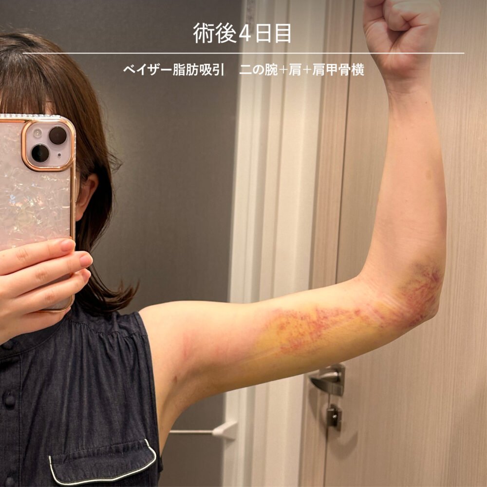 二の腕脂肪吸引のダウンタイム経過の症例写真