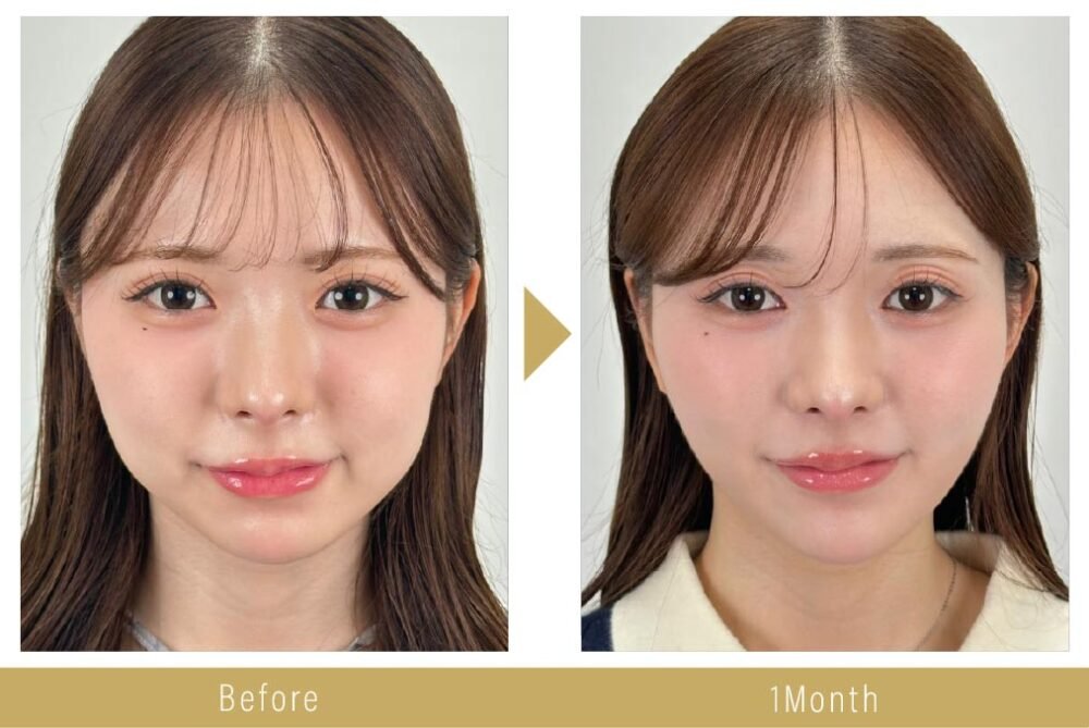 エンブレイスRFの解説用画像