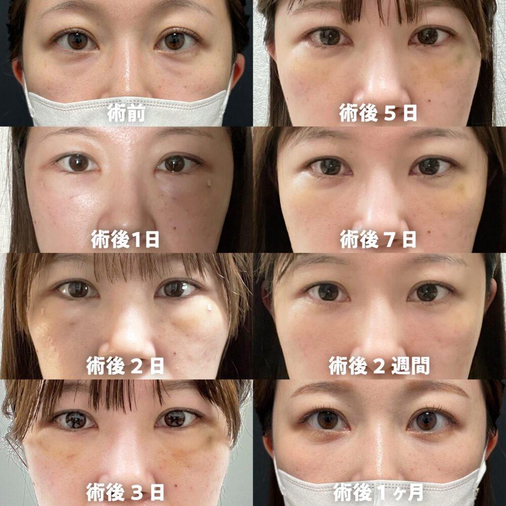 裏ハムラ法のダウンタイム経過の症例写真