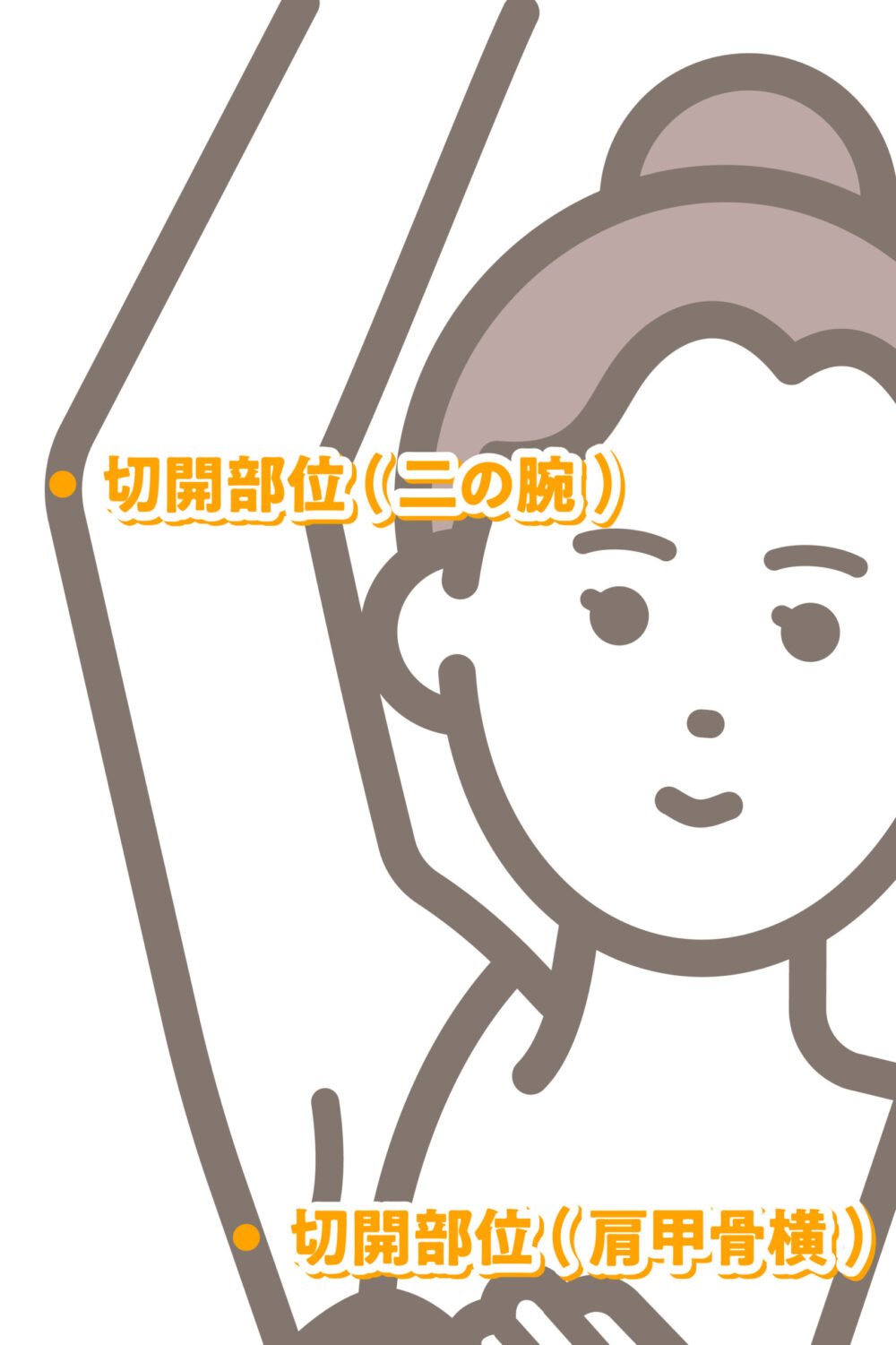 二の腕脂肪吸引の傷口の位置
