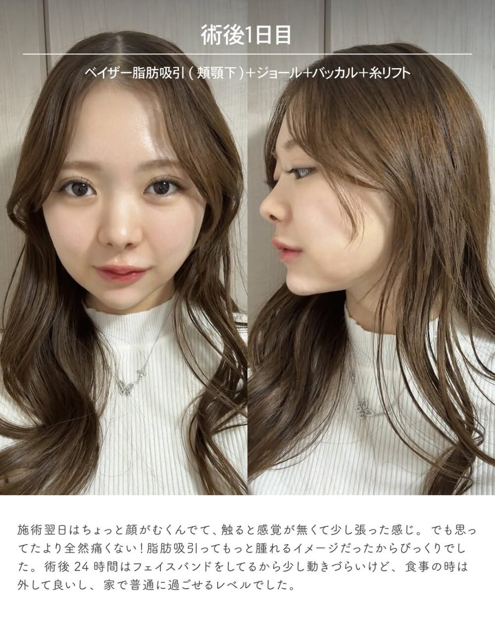 エンブレイスRFの症例写真
