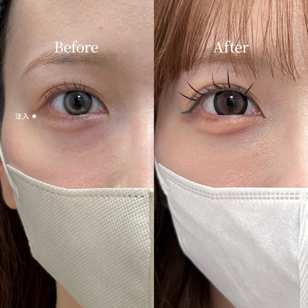 脂肪注入の症例写真（術前・術後）