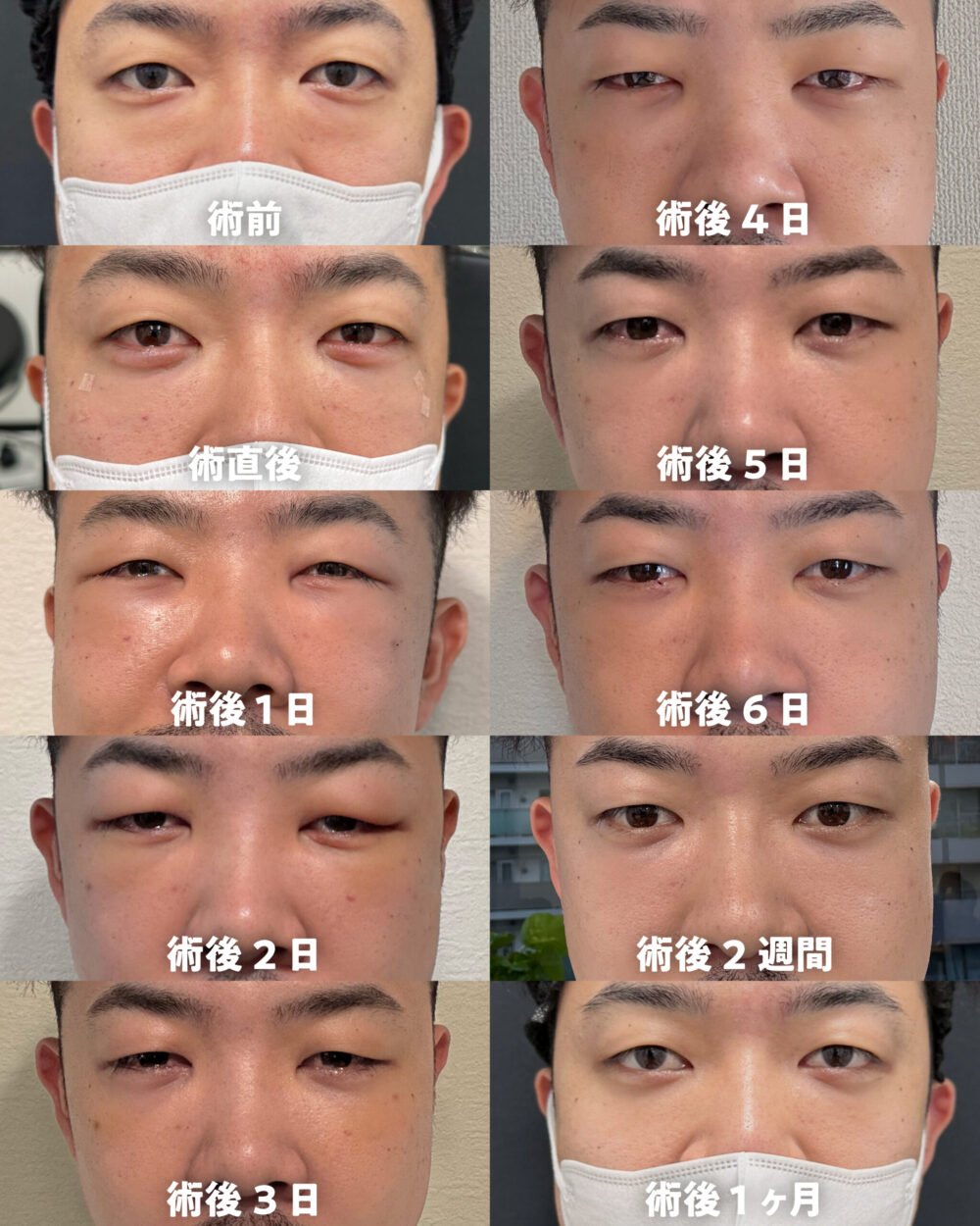 クマ取りのダウンタイム経過の症例写真