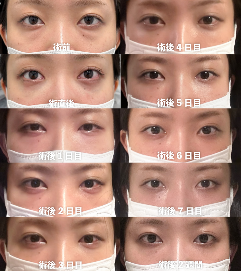 裏ハムラ法の症例写真（術前・術後）