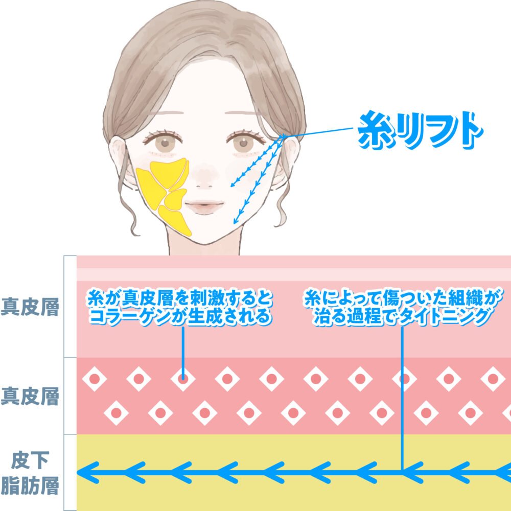 小顔脂肪吸引の解説画像