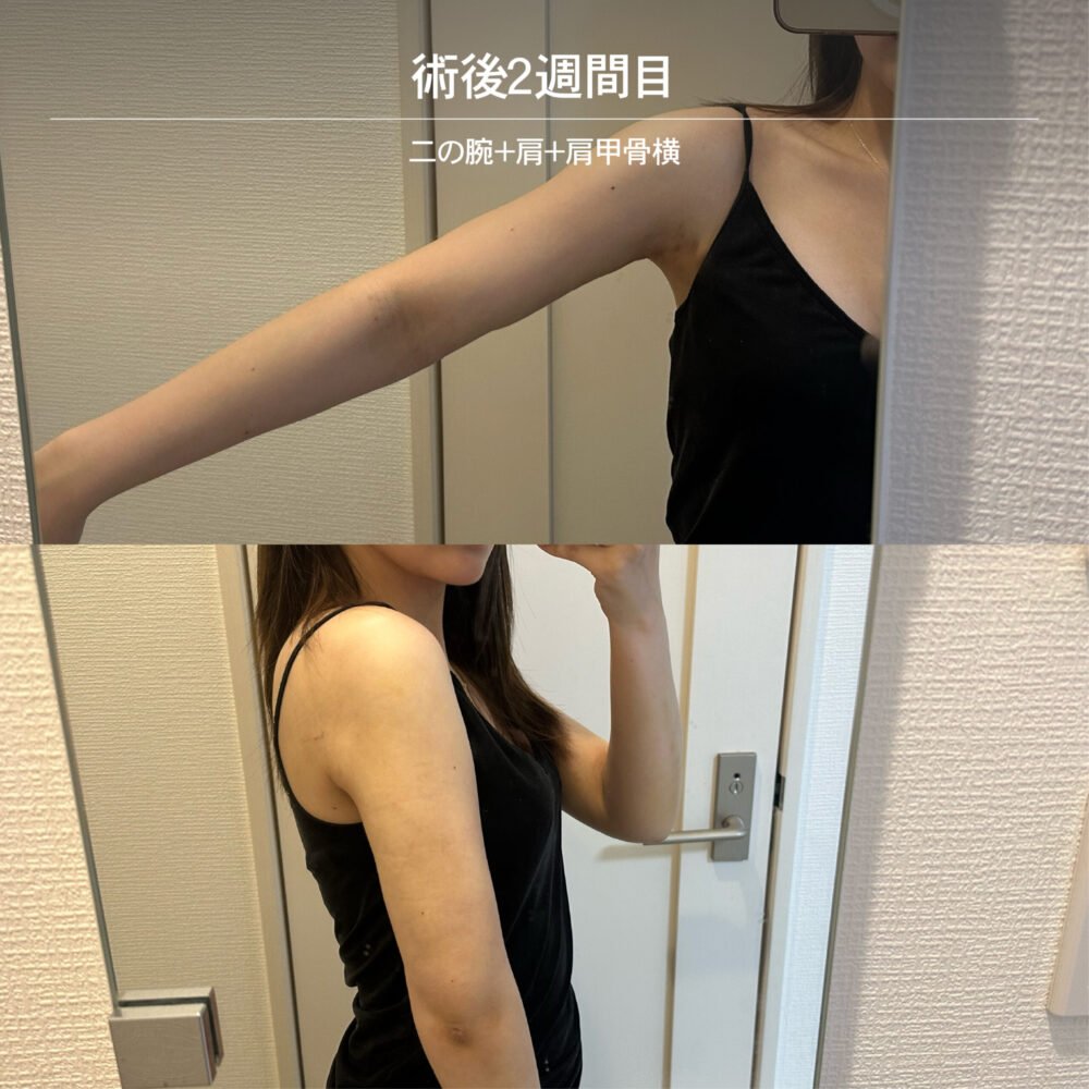 二の腕脂肪吸引のダウンタイム経過の症例写真