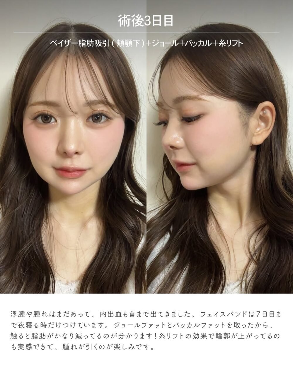 エンブレイスRFの症例写真