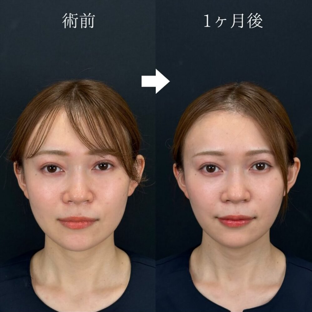 糸リフトの症例写真