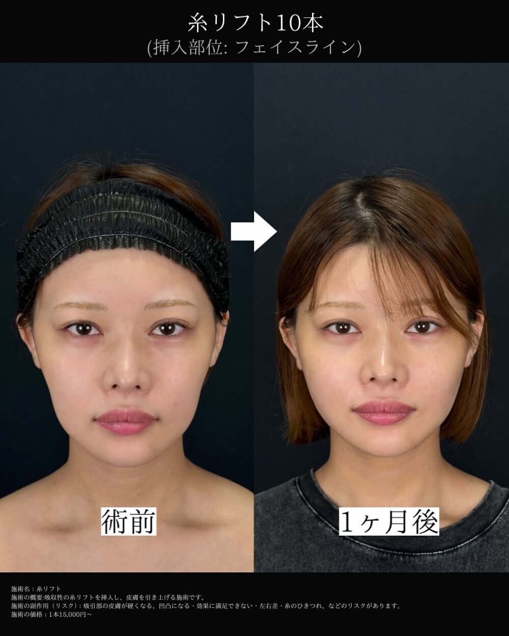 糸リフトの症例写真