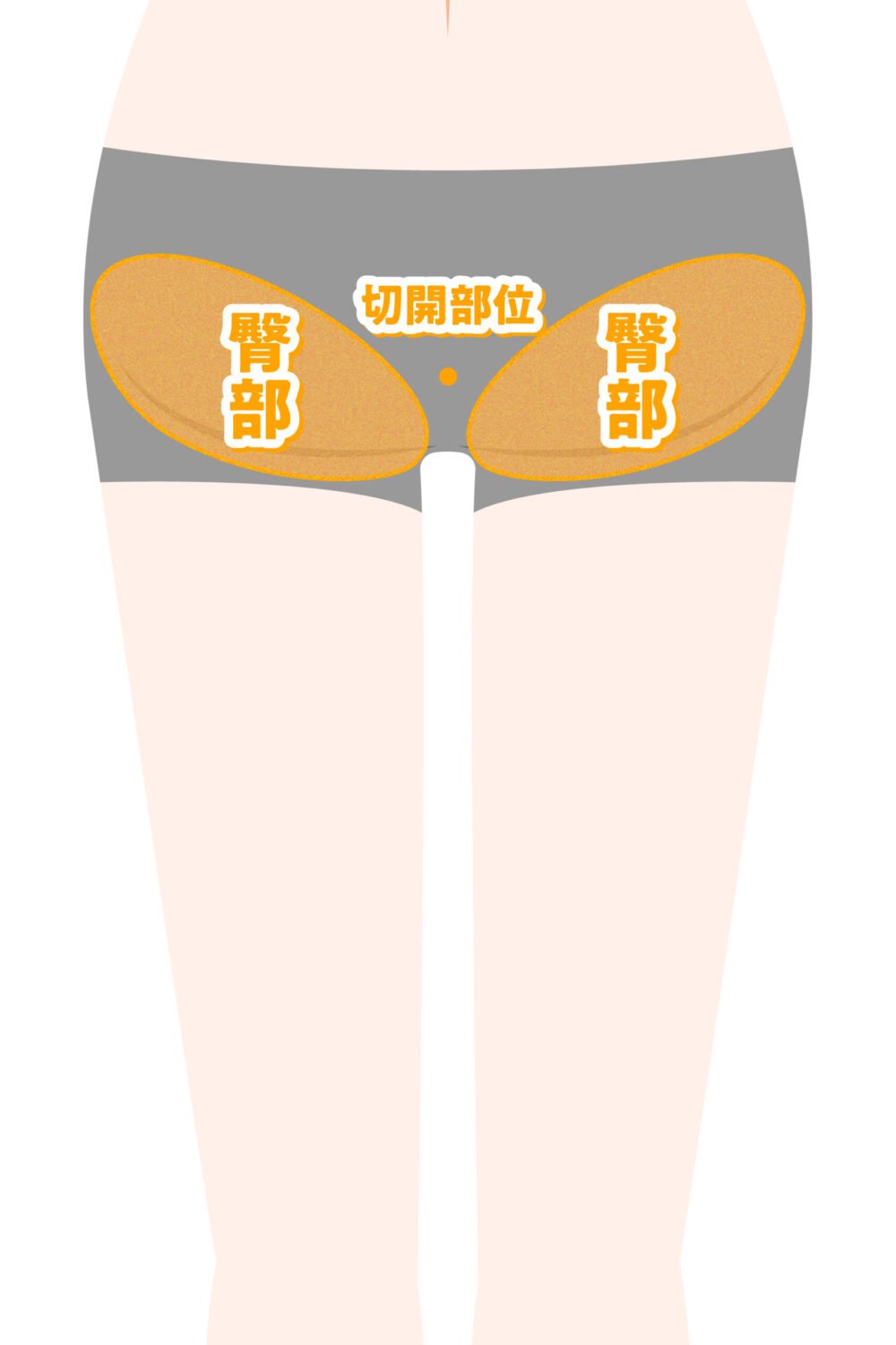 太もも脂肪吸引の施術部位の図解