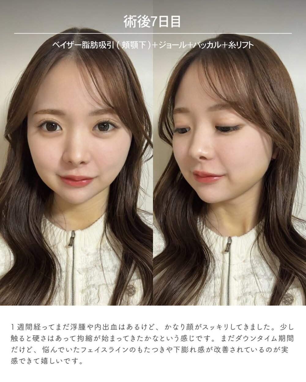 エンブレイスRFの症例写真