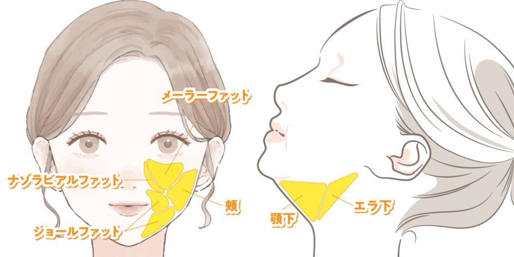 小顔脂肪吸引の施術部位の図解