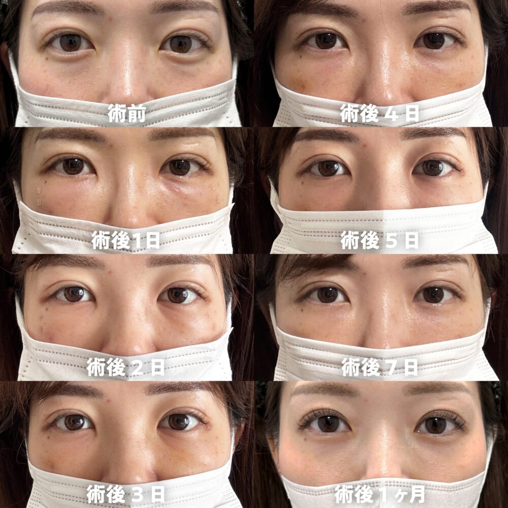 裏ハムラ法のダウンタイム経過の症例写真