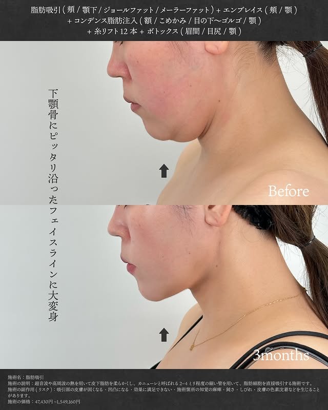顔の脂肪吸引の症例写真