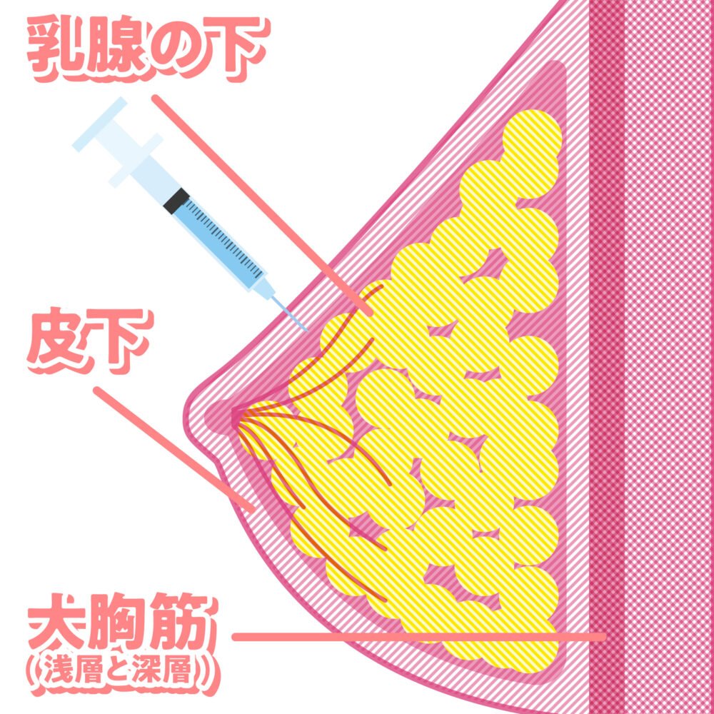 脂肪豊胸の注入構造の解説画像