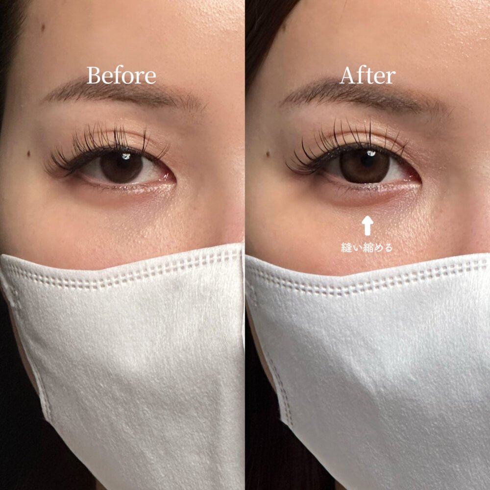 脂肪注入の症例写真（術前・術後）