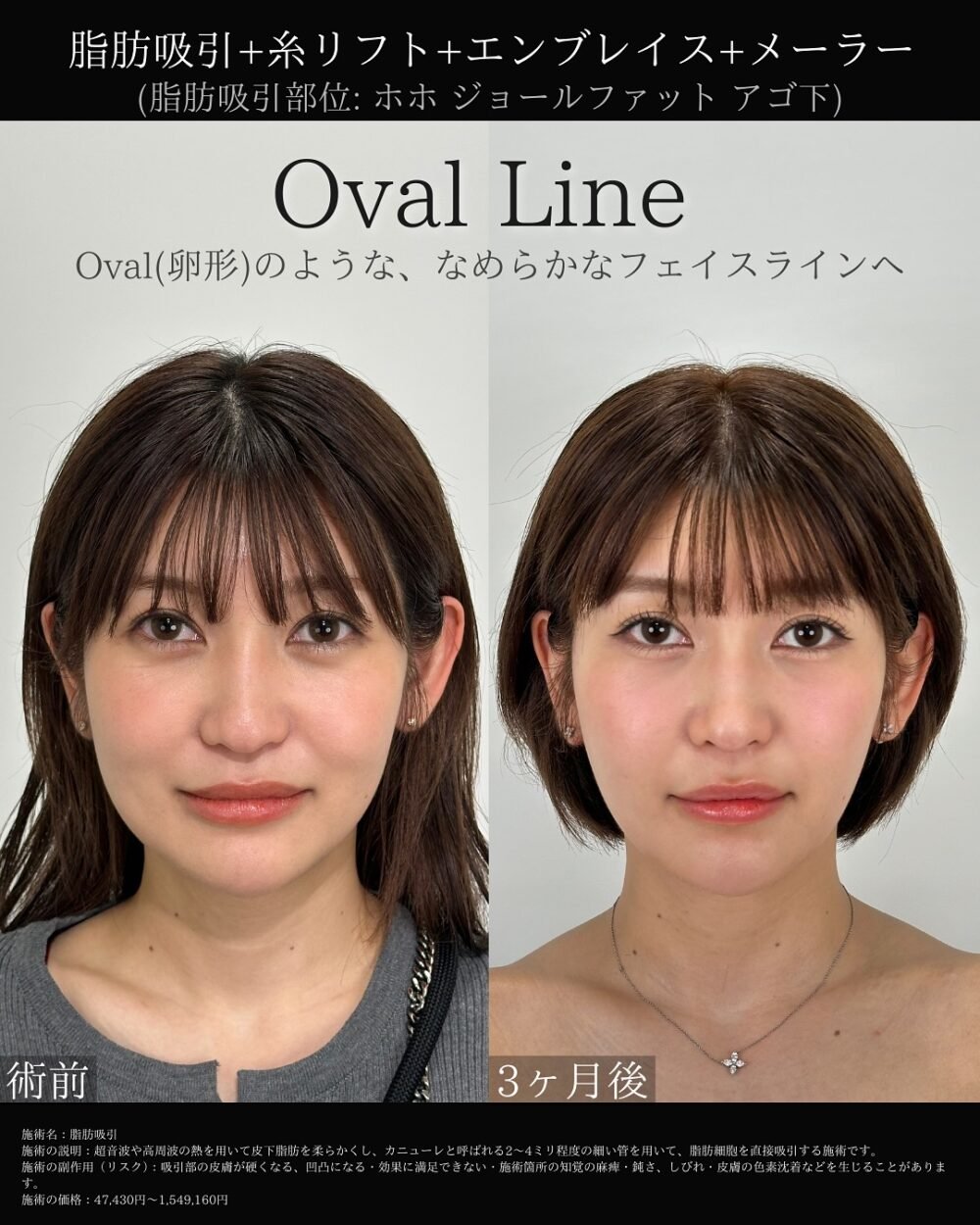 顔の脂肪吸引の症例写真
