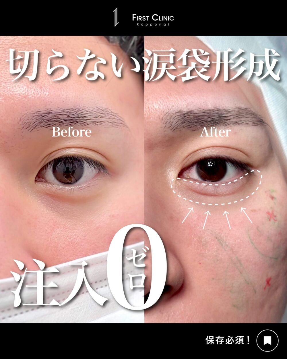 切らない涙袋形成の症例写真