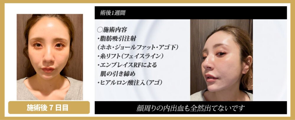 脂肪吸引注射のダウンタイム経過（術後7日目）