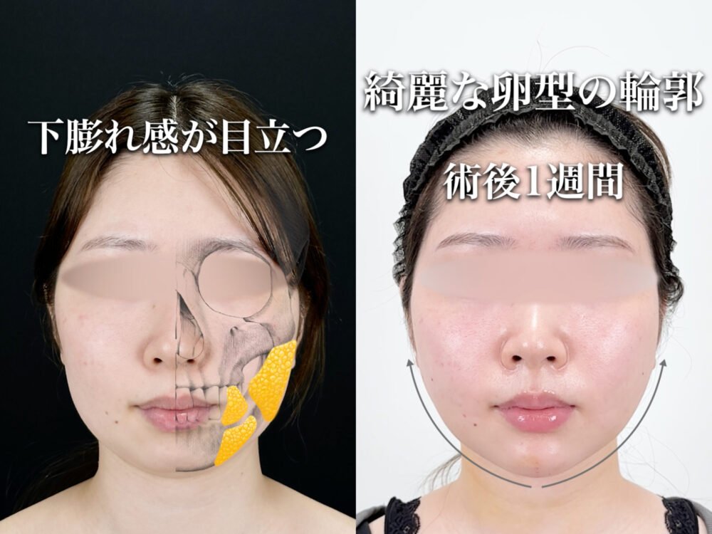 小顔脂肪吸引の解説動画のスクリーンショット