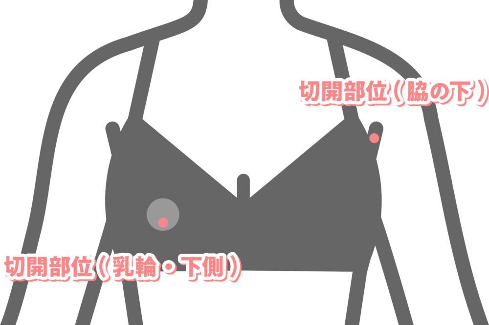 脂肪豊胸の傷口の位置